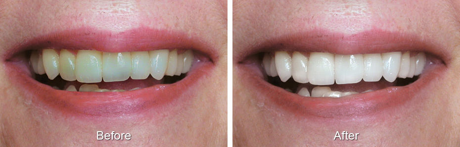 Dental before and after photo - Alexandria