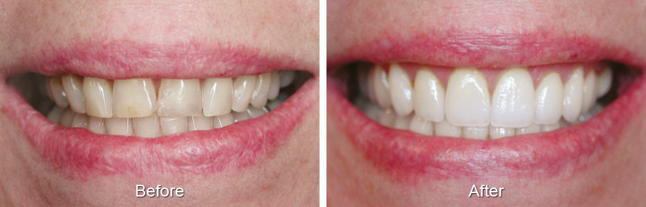 Dental before and after photo - Alexandria