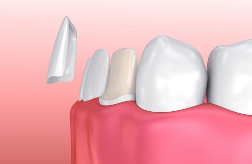 Cosmetic Dental Veneers