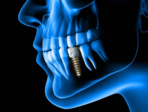 What to Expect From a Dental Implant Procedure