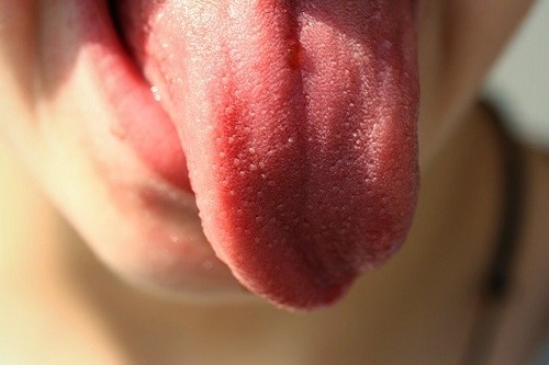 Tongue Discoloration & Overall Health